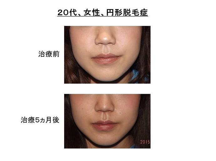 円形脱毛症　病院""